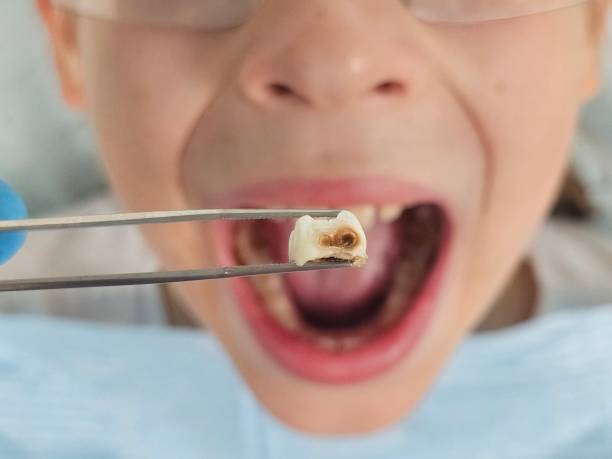 Best Cracked Tooth Emergency Dentist  in Mount Carmel, OH